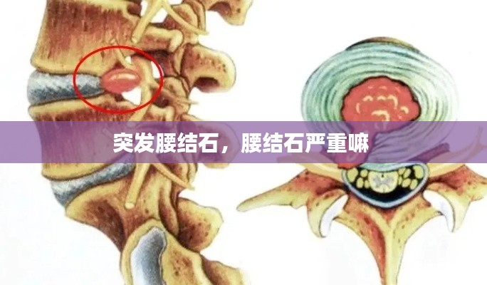 突发腰结石，腰结石严重嘛 